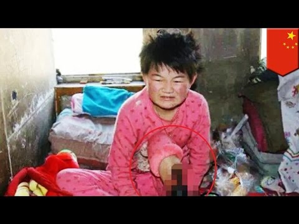 Child leg amputation: 11 year old girl needs surgery to survive, family too poor - TomoNews