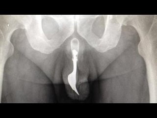 Fork in penis: Australian man shoves fork all the way in