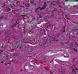 Histopathology Spleen--Sickle cell disease
