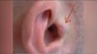 Man implants 'invisible headphones' in ears