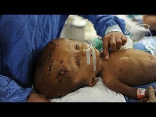 Baby girl with hydrocephalus undergoes skull remodelling operation