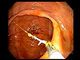 Live "Whip WORM" inside the human body- Colonoscopy in New York ( whip worm Trichuris Trichiura )