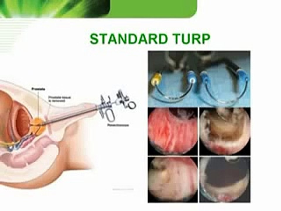 prostate treatment, what is the prostate, prostate symptoms, prostate protection