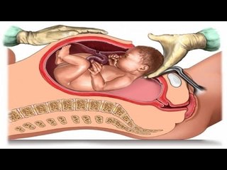 メキシコで少女９歳が出産　父親は行方不明