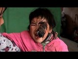 中国内陸の貧困浮き彫りに　雲南のがん幼児逝く