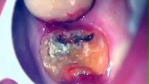 severe decay removed on root and tooth is saved from extraction