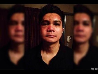 Vhong Navarro, bugbog sarado sa mga kuhang larawan