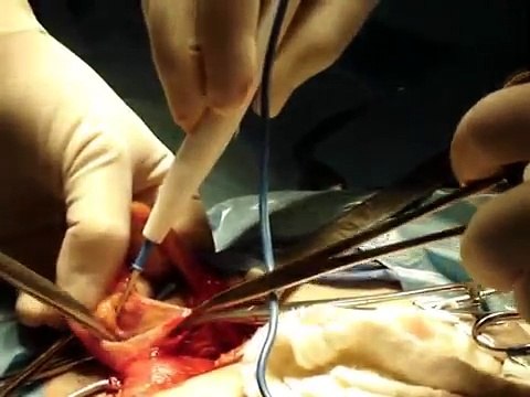 Operacion De 3 Hernias y un Varicoceles