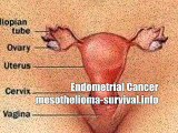 Endometrial Cancer: Endometrial Cancer Is Treatable