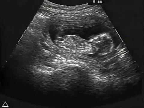 Fetal Alcohol Damage