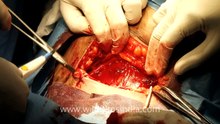 Caesarean section : a new human being enters the world!