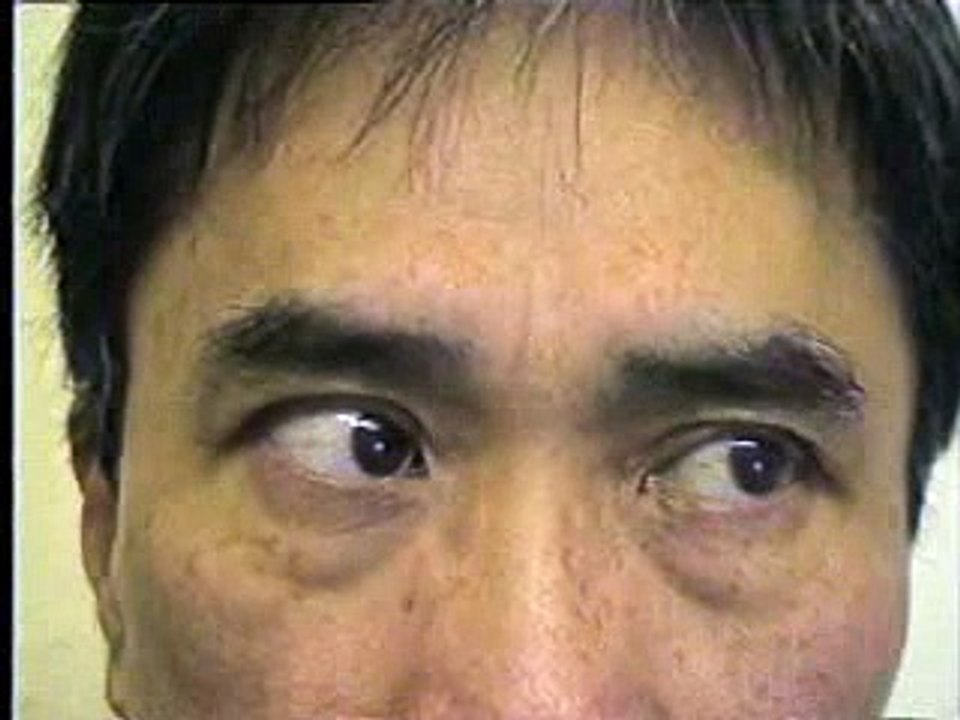 6th nerve palsy