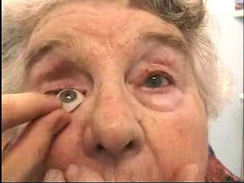 Examination of an enucleated socket