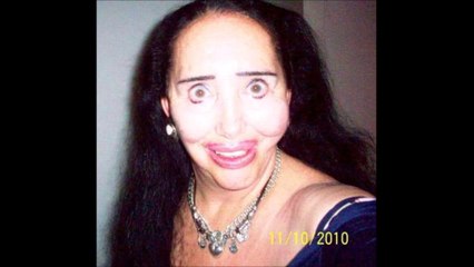 Plus gros ratés en chirurgie esthétique