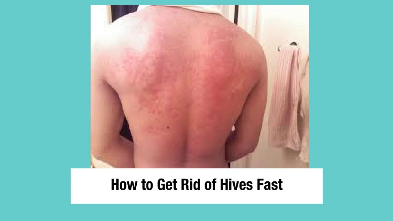 How to Get Rid of Hives Fast Naturally