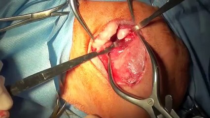 Dog Excision Arthroplasty 1 At Southpaws Specialist Veterinary Surgery, Melbourne Australia