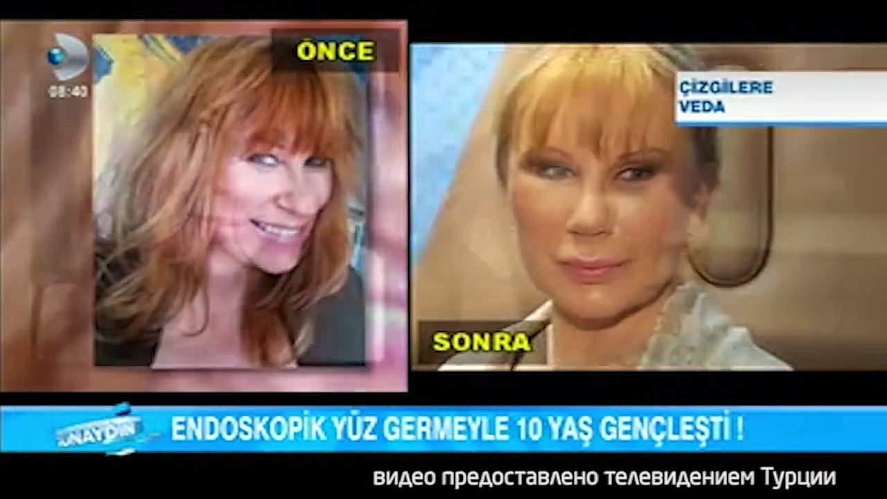 Elithairtransplant Istanbul - Haartransplantation in der Türkei Istanbul  - Dr.Abdulaziz Balwi