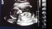 Cute & Clear Ultrasound of baby Lucky { 19 weeks ultrasound , anatomy scan }