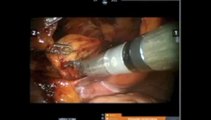 Robotic Bilateral Inguinal Hernia Repair