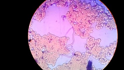 Live Microfilaria(Parasite) In Blood Under Microscope, Captured In My Camera