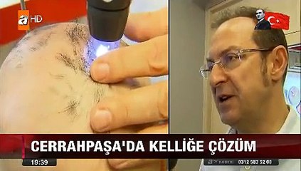 Cerrahpaşa'da kurulan özel bölümde saçları dökülüp kel kalan genç kızın saçları kurtarıldı