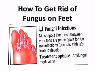 How To Get Rid of Fungus on Feet