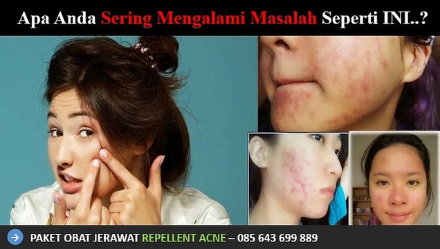 0856 4369 9889, Sabun Penghilang Jerawat yang Ampuh