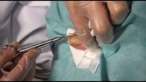 ingrown Toenail Removal Podiatrist ! HD WATCH