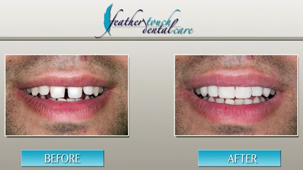 Dental Veneers - Atlanta, GA - Feather Touch Dental Care