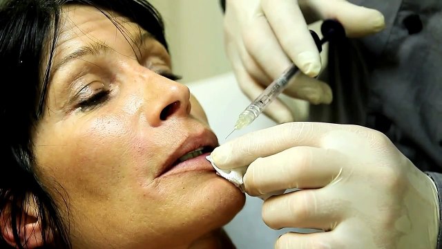 Injection d'acide hyaluronique : traitement des lèvres