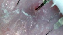 Ingrown Hair Pimple