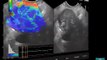 Pancreatic Cancer -- Advanced EUS Imaging: Real-Time EUS Elastography