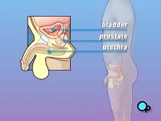 PreOp®  Patient Education: TURP Prostate Surgery