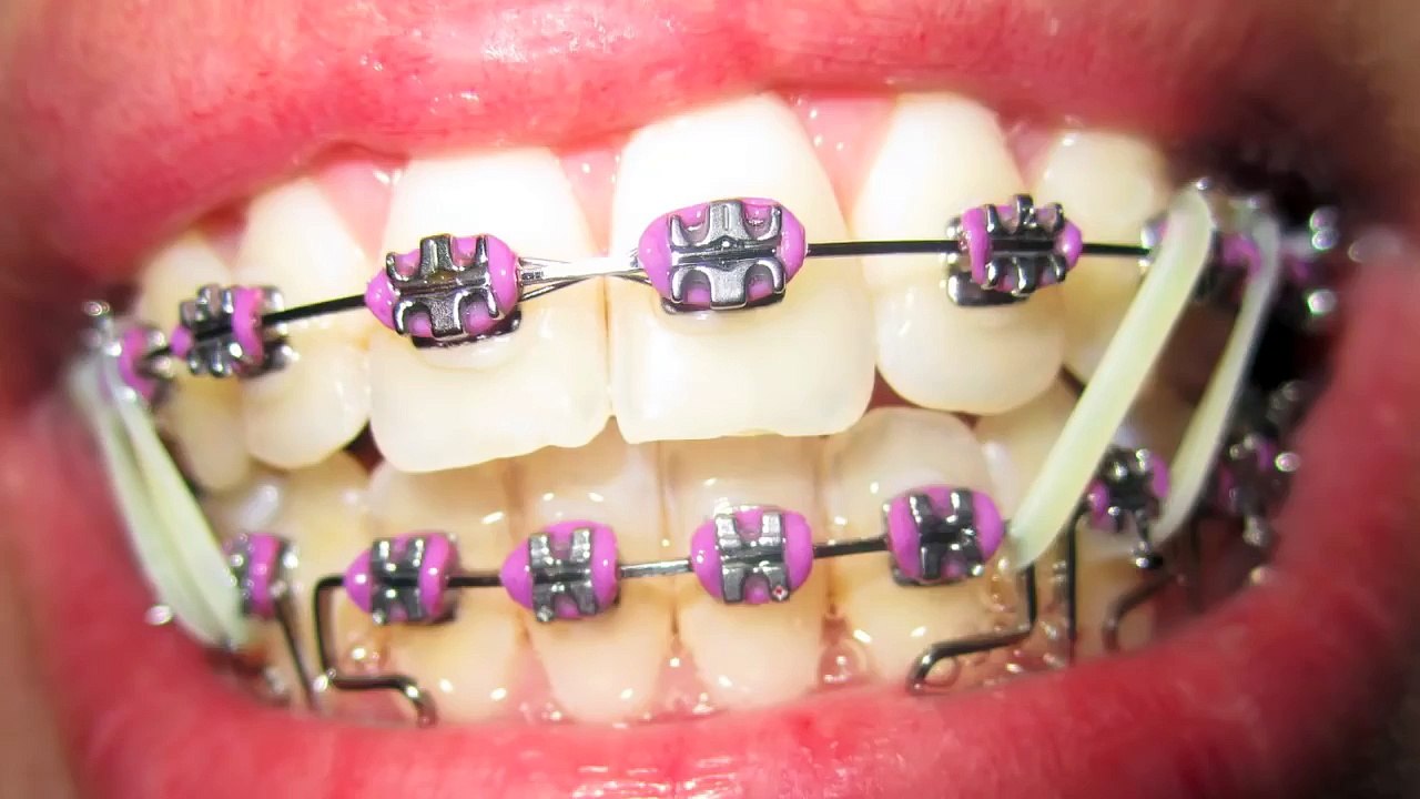 Braces Update # 13 Eight Elastics