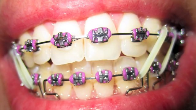 Braces Update # 13 Eight Elastics