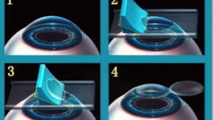 LASIK : A Real Eye Surgery