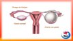Remedios caseros para los quistes ovaricos - Tratamientos naturales para los quistes de ovarios