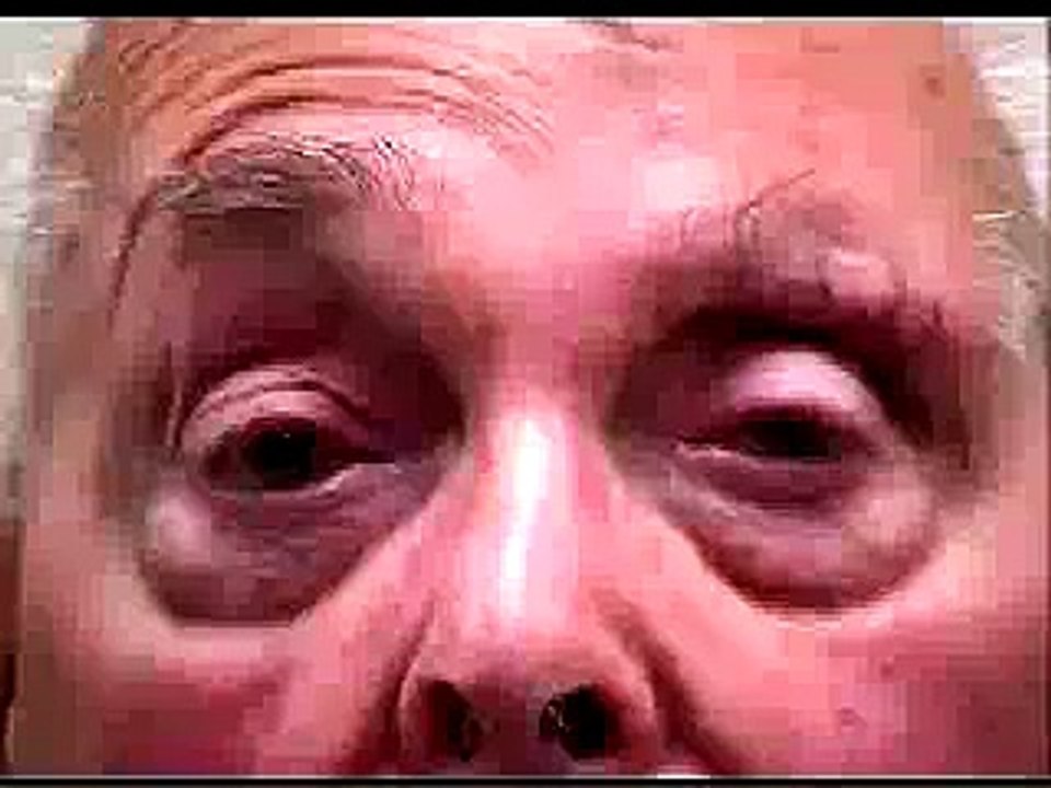 apraxia facial