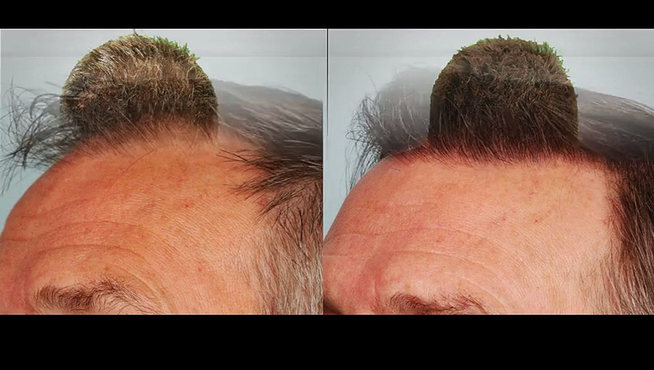 Hair Transplantation Procedure