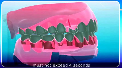 Descargar video: Implantes Dentales Sin Cirugía Implantes dentales baratos Madrid Dental implants without surgery impianti dentali