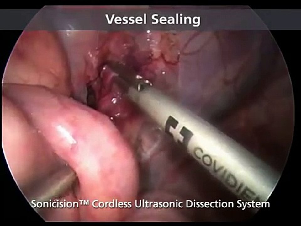 Sonicision™ Ultrasonic Dissection: Surgical Techniques