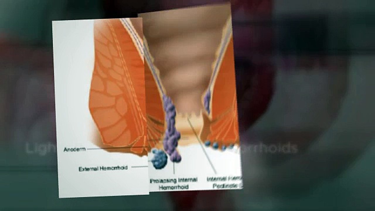 Venapro Hemorrhoids Solution