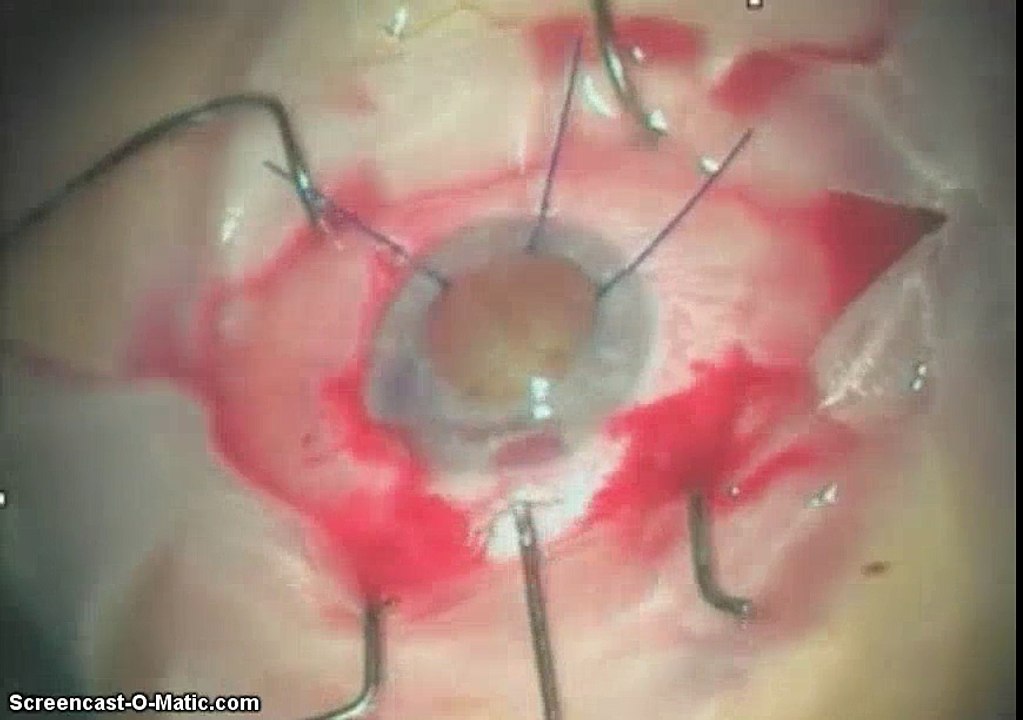 Albino Catract Extraction with Reper Iris Prothesis by Dr. Irfan Kundi F.R.C.S (UK)