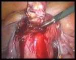 myomectomy, Laparoskopi ile miyom ameliyatı www.tupbebek.com