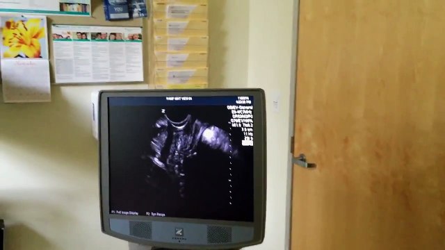 8 weeks ultrasound. Baby moves.