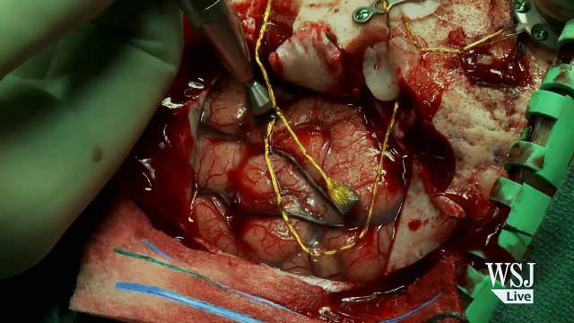 Un bras artificiel actionné par la pensée