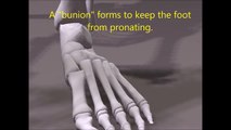 Bunion removal without surgery? Is removing a bunion with surgery a dumb idea?