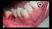 remaining tooth extraction and dental implant procedure Prof Dr Rashad Murad