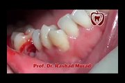remaining tooth extraction and dental implant procedure Prof Dr Rashad Murad
