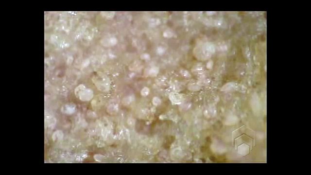 Scabies mites on skin crust